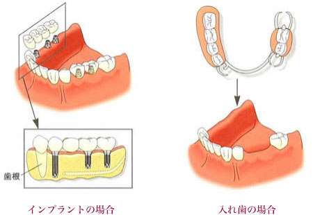 入れ歯とインプラント、選ぶポイント