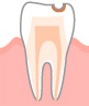 C1 エナメル質の虫歯