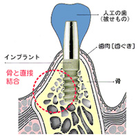 インプラント治療とは