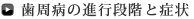 歯周病の進行段階と症状